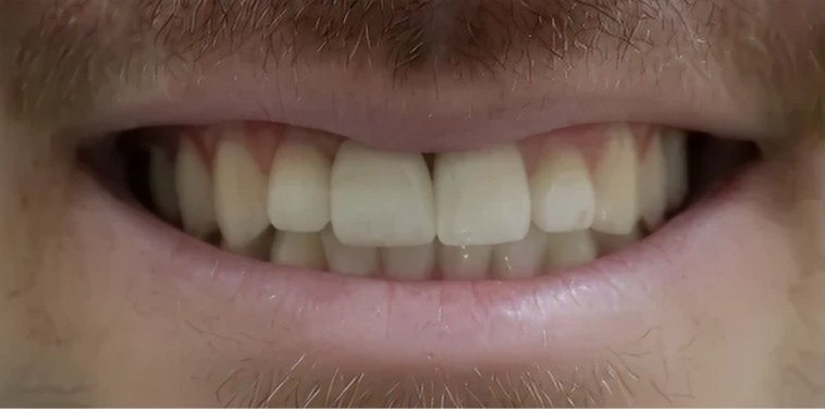 After Single Tooth Implant