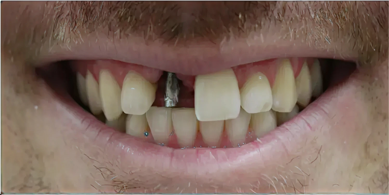 Before Single Tooth Implant
