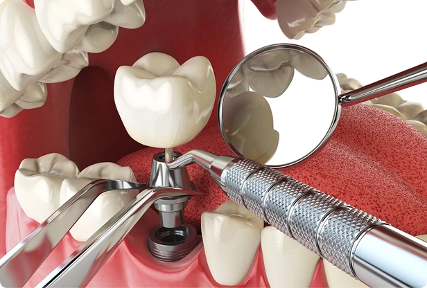 Same-Day Implant Placement