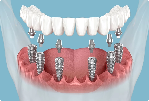 Durable Implant-Supported Bridges