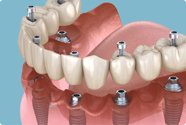 Full Arch Teeth Solutions
