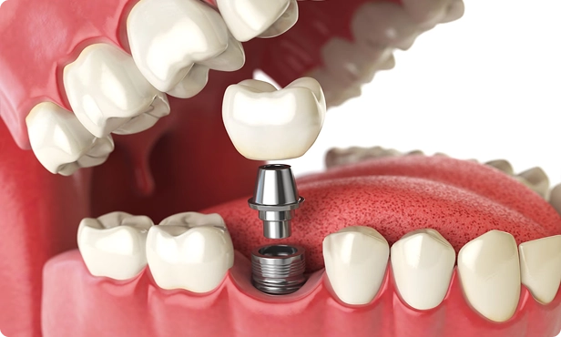 Immediate Same-Day Dental Implants
