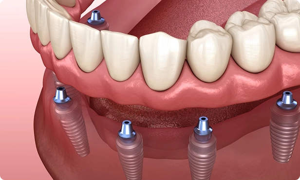 Stabilize Denture Implants