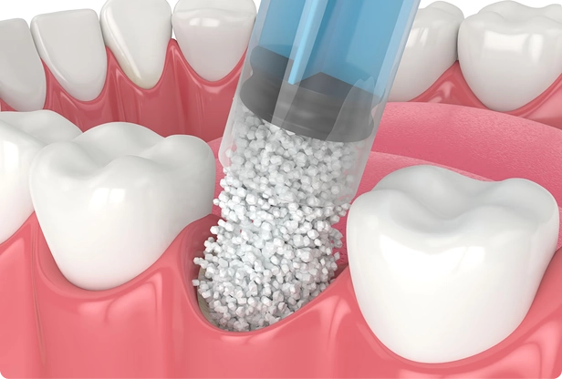Advanced Dental Bone Grafting